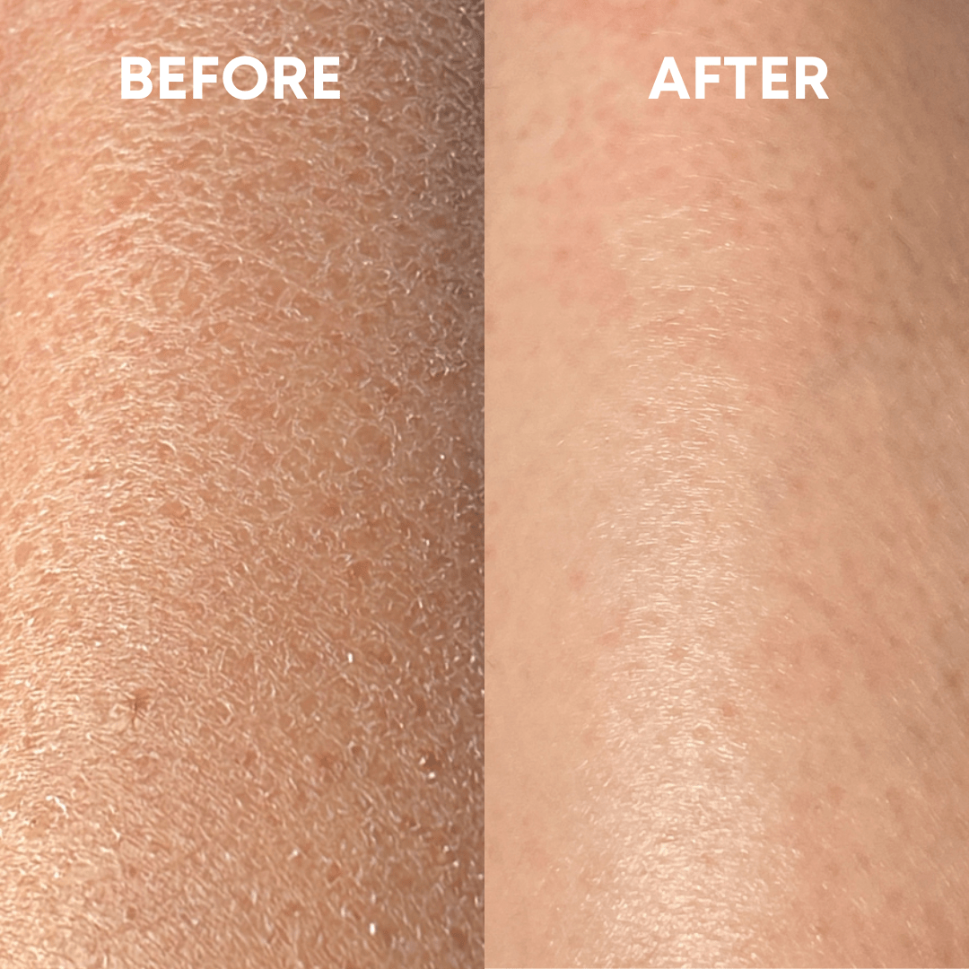 Side-by-side comparison of skin showing results before and after treatment with the CheekyGlo Exfoliating Glove. The left side labeled "BEFORE" displays dry, flaky skin, while the right side labeled "AFTER" showcases smoother, hydrated skin treated by CheekyGlo.