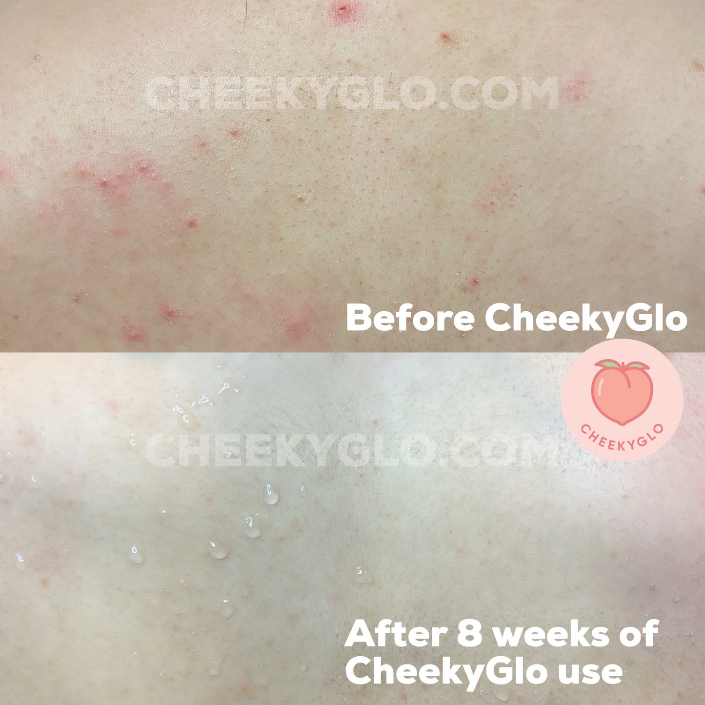 A side-by-side skin comparison with the top image showing a person's skin with acne and the text “Before CheekyGlo.” The bottom image showcases significantly clearer, smoother skin after 8 weeks of using the CheekyGlo Exfoliating Glove, labeled “After 8 weeks of using CheekyGlo Exfoliating Glove.”