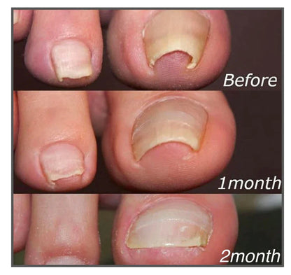 NAIL CORRECTION PATCHES