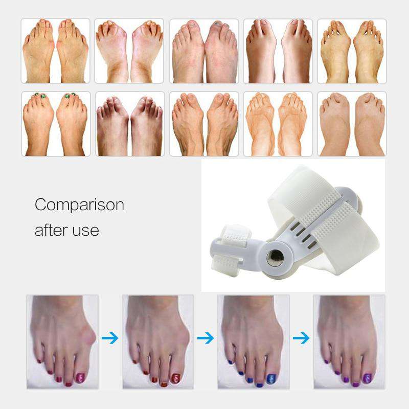 ORTHOPEDIC BUNION CORRECTOR